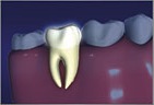 Root Canal1