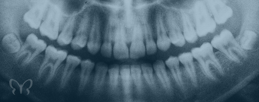 service middle root canal